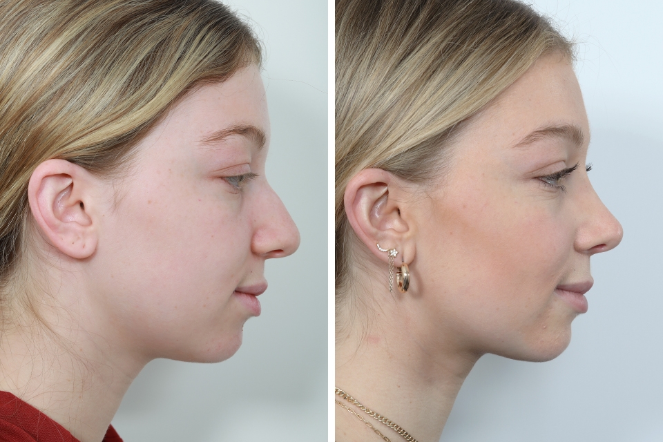 best revision rhinoplasty surgeons nyc