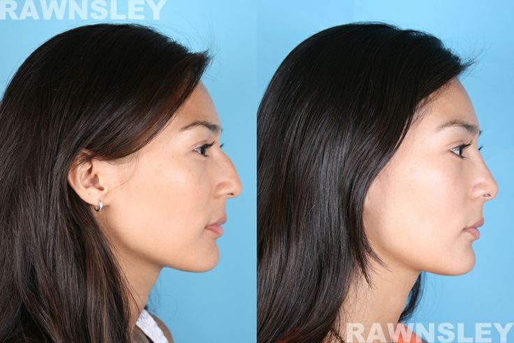 best revision rhinoplasty surgeons nyc