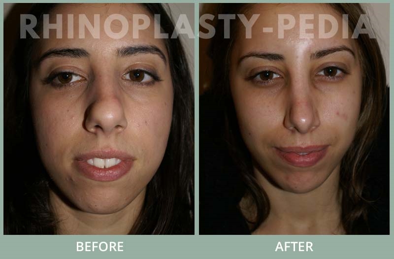 best revision rhinoplasty surgeons nyc