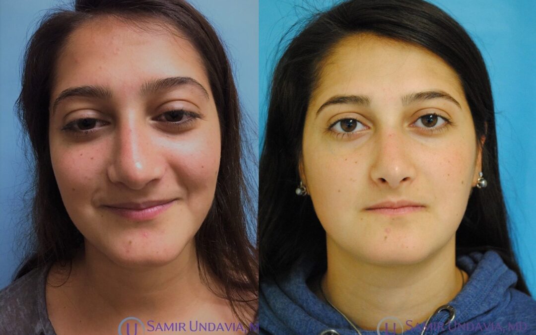 Rinoplastica – rhinoplasty experts