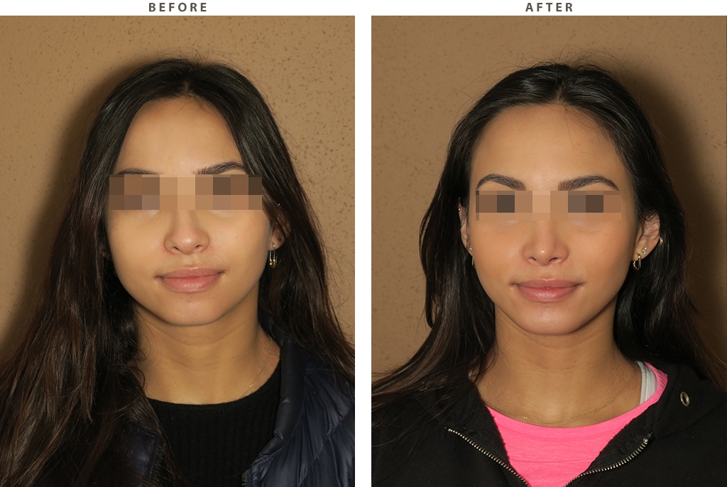 rhinoplasty experts